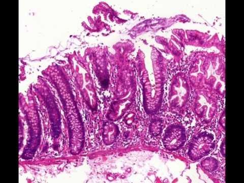 Sessile Serrated Adenoma