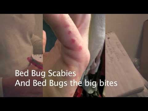 scabies burrow marks #11