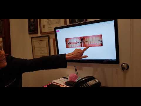 Treating Open Bites with Invisalign in New York City NY - Park Avenue Orthodontics