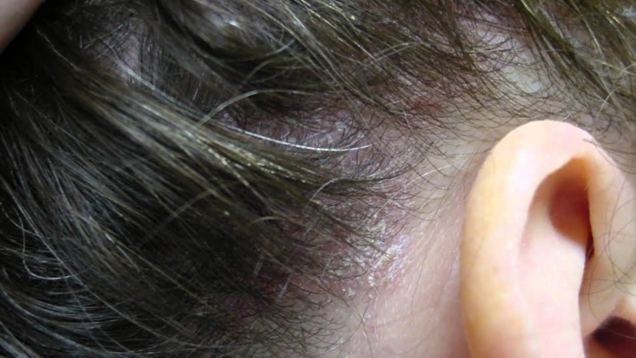 pimples-on-scalp-youtube