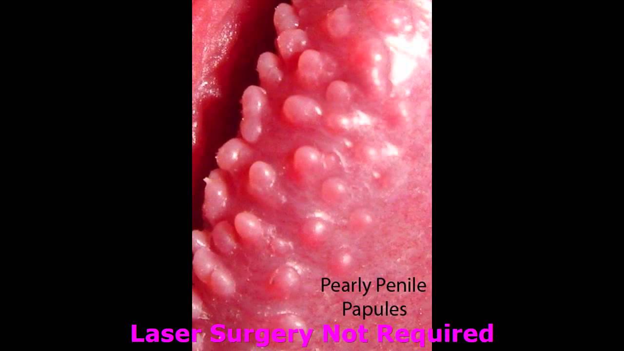 Penile treatment natural pearly papules How to