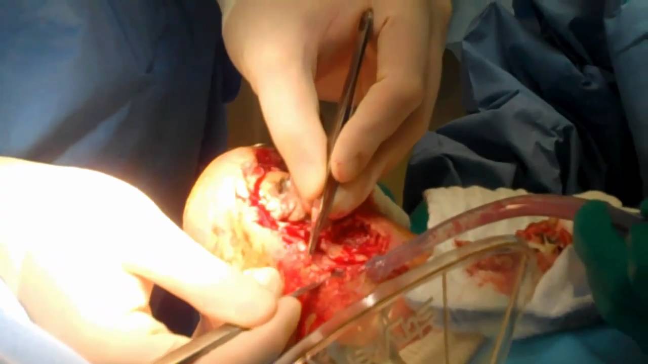 Heel Ulcer Debridement with Calcanectomy and Graft Jacket/ A - YouTube