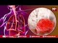 క్యాన్సర్ రోగులకు గుడ్ న్యూస్ | Russia Good News On Cancer Patients | Sitaralu Sudaro News  - 02:59 min - News - Video