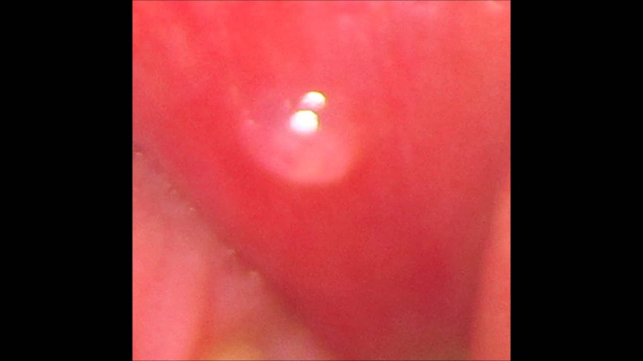 Water Blister Inside Mouth 55