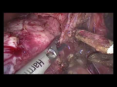 Laparoscopic Hysterectomy Specialist | Dr Preeti Gandhi