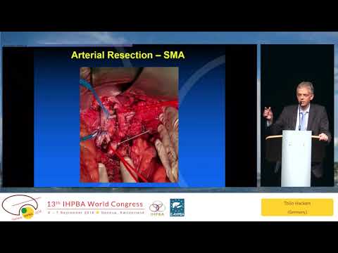 DEB06.1 Heidelberg Surgical Approach Versus Conventional Management of Pancreatic Adenocarcinoma