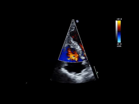 Upload mp3 to YouTube and audio cutter for Ventricular Septal Rupture After Acute Myocardial Infarction download from Youtube