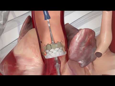 Edwards Lifesciences SAPIEN 3 TAVR procedural animation Edwards Lifesciences SAPIEN 3 TAVR procedural animation