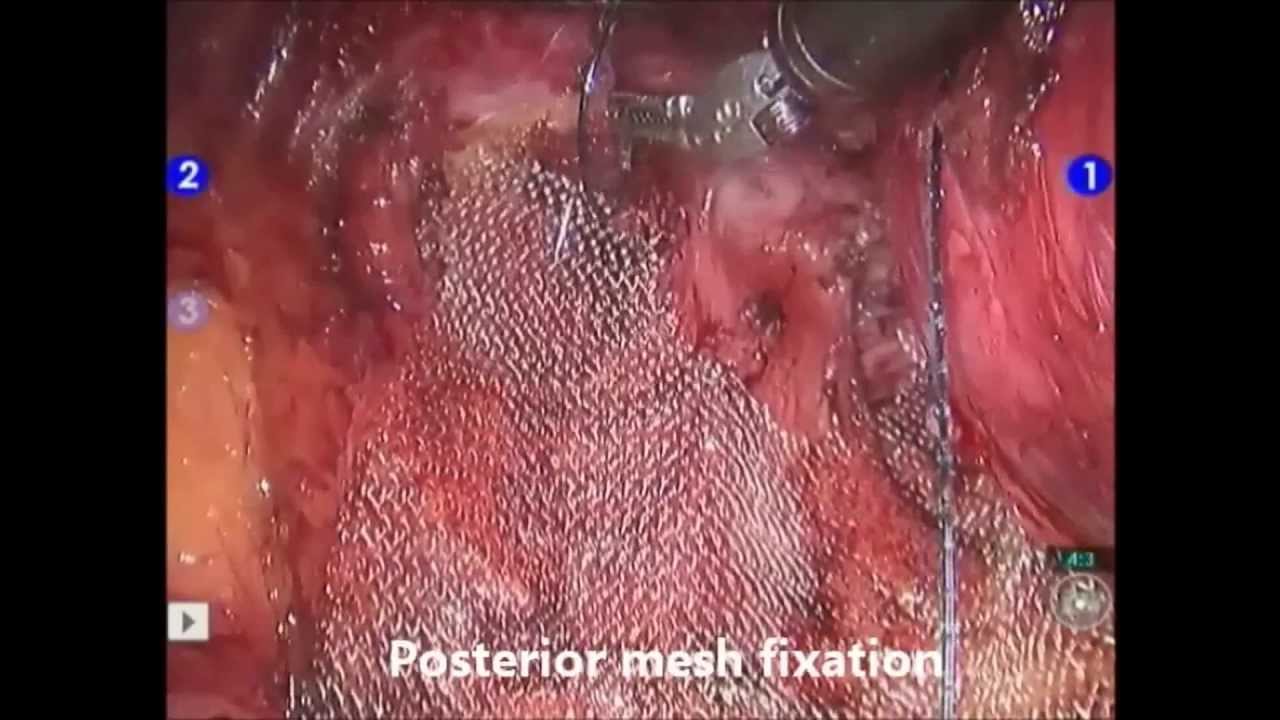 Vaginal Vault Prolapse Surgery