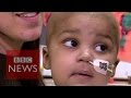 BBC : 'Miracle' genetic therapy saves baby with leukemia