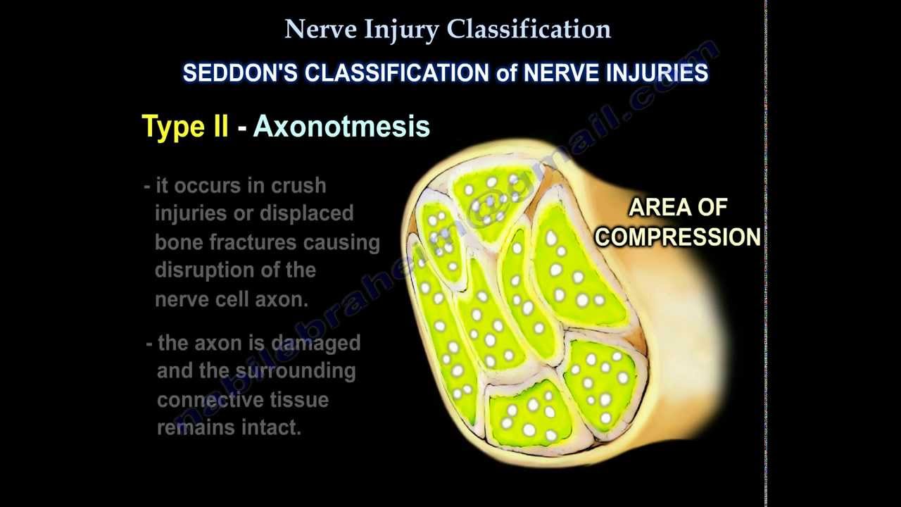 Nerve Injury Types Nerve Recovery Everything You Need To Know Dr Nabil Ebraheim YouTube