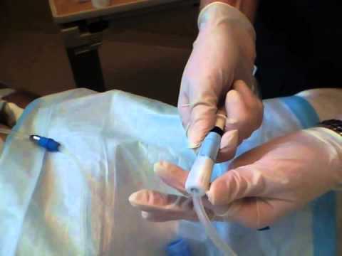 Peritoneal Dialysis Sampling - YouTube