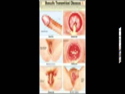 transmitted sexually diseases symptoms disease std sign treatments