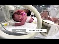 GRAPHIC WARNING: Gazan baby saved from her dead mothers womb dies | REUTERS  - 02:13 min - News - Video
