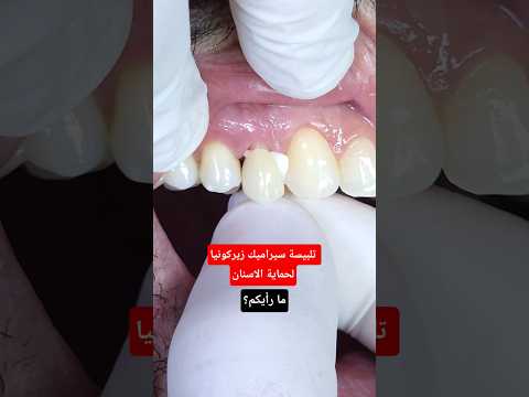 تلبيسة سيراميك زيركونيا لحماية الاسنان