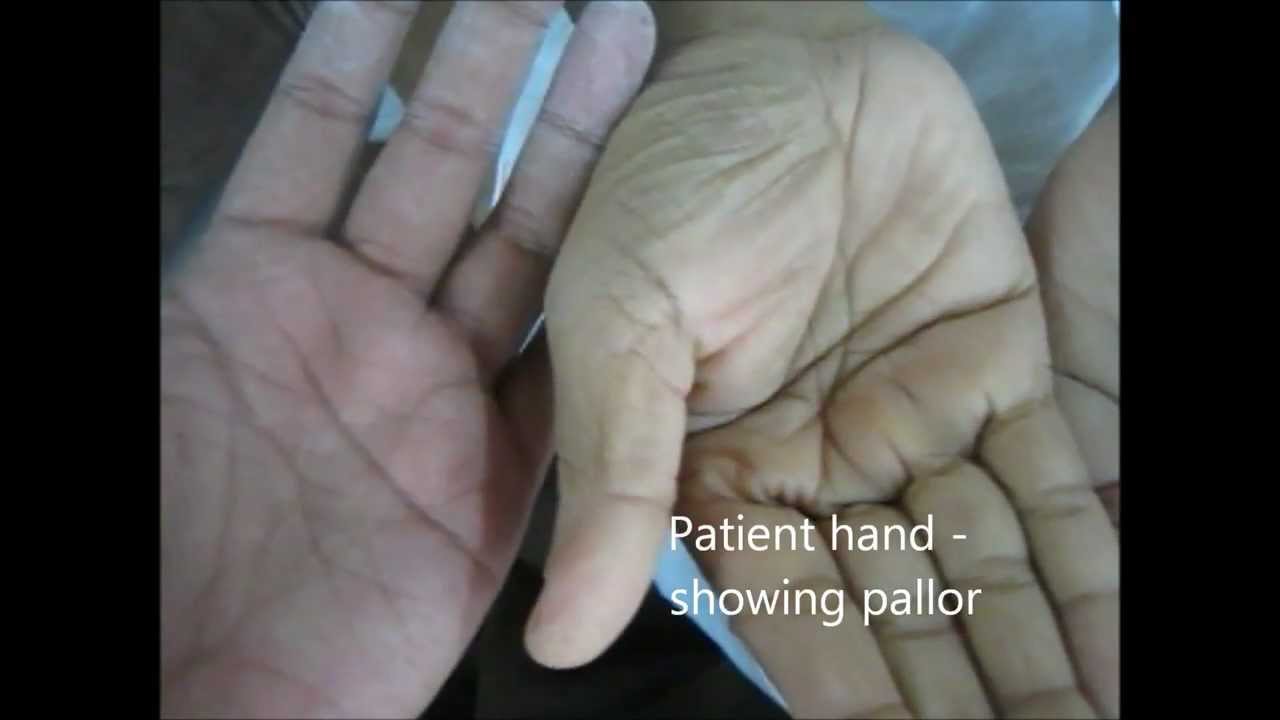 How To See Pallor In General Examination? YouTube