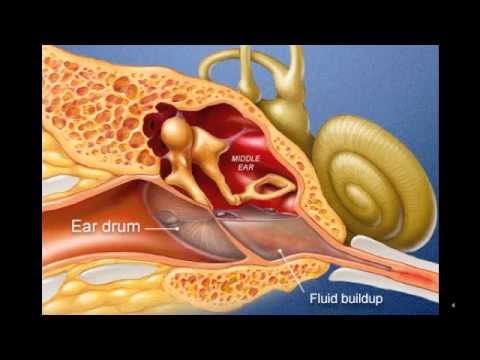 Ear Infection - YouTube eardrum diagram 