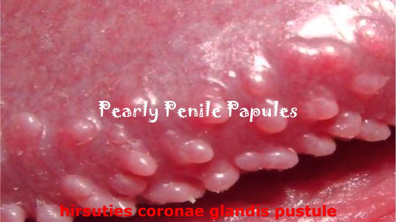 Pearly penile papules on glans
