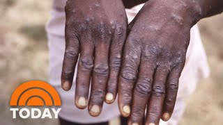 CDC Says Monkeypox Spreads Through Physical Contact