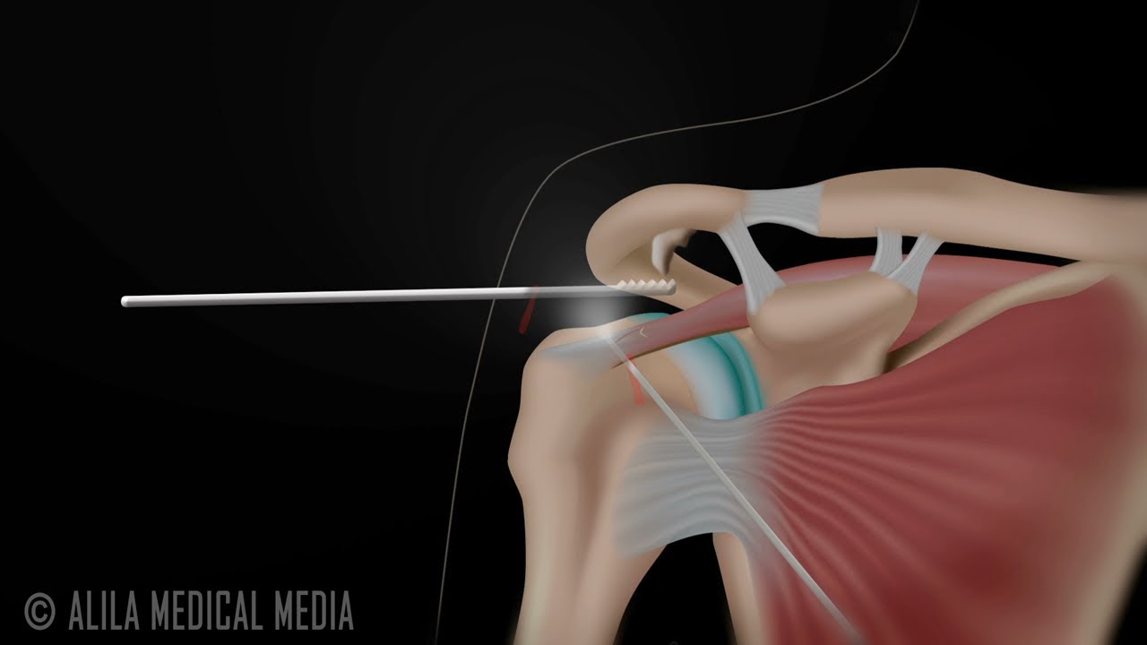 Subacromial Decompression And Arthroscopic Rotator Cuff Repair Animation Youtube