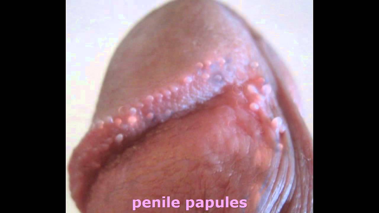 On shaft papules penile Multiple brownish