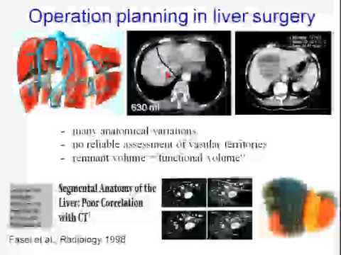 Assessment of Liver Function for extensive hepatic resection 