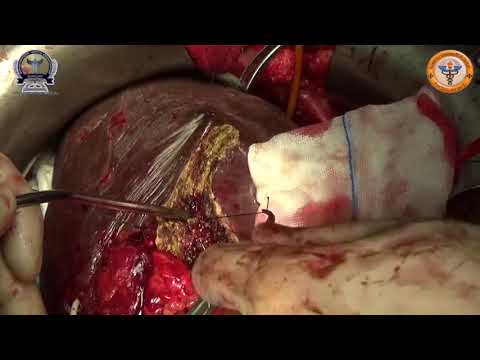 Hepatopancreatoduodenectomy (HPD) with Portal Vein Resection for Cholangiocarcinoma