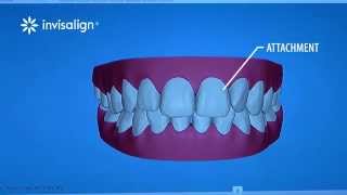 What You Can Expect During Invisalign Treatment