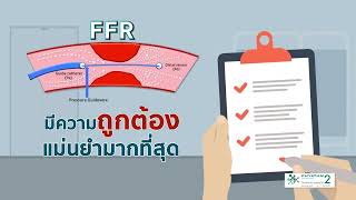 OCT FFR for treating coronary artery disease