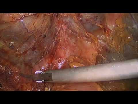 Laparoscopic Roux-en-Y Hepaticojejunostomy for Bile Duct Stenosis