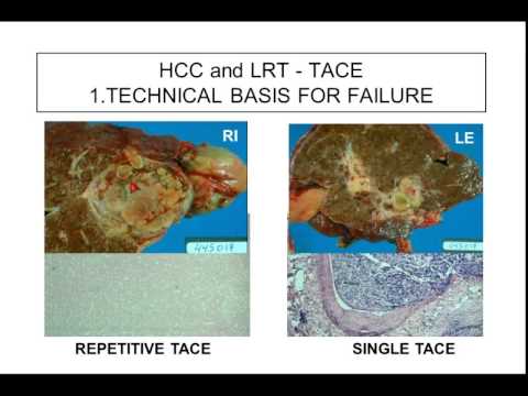 The optimal pretransplant treatment of hepatocellular cancer? 