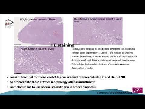 US05: Risk Stratification of Hepatic Adenomas; How Accurate? 