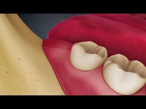 wisdom tooth removal using laser