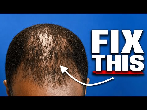 how I STOP hair loss as a Black Man ( FULL routine)