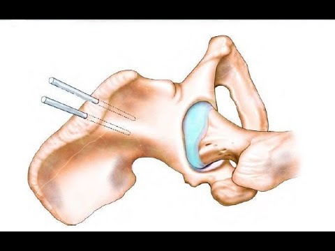 External Fixatıon Technique for pelvis