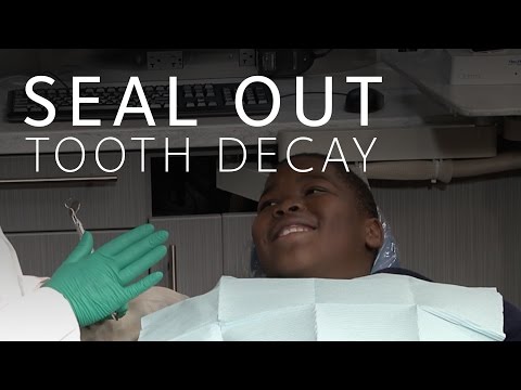 Dental Sealants for Children Dental Sealants for Children