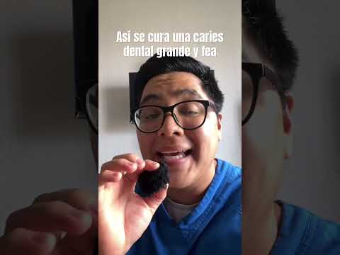 Caries dental fea y grande #cariesdental