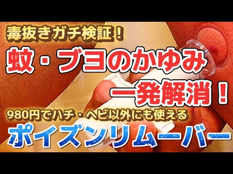 【虫刺され】ポイズンリムーバーの使い方！虫よけ対策おすすめグッズ