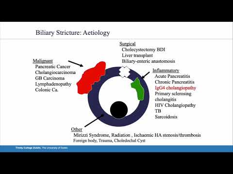 US02: Management of Benign Bile Duct Stricture 