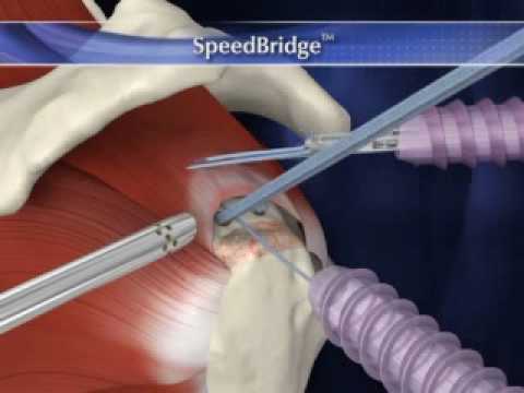 SpeedBridge.wmv - YouTube