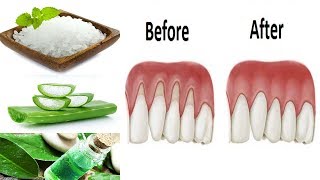 Gum Disease Treatment at Home with Natural Remedies