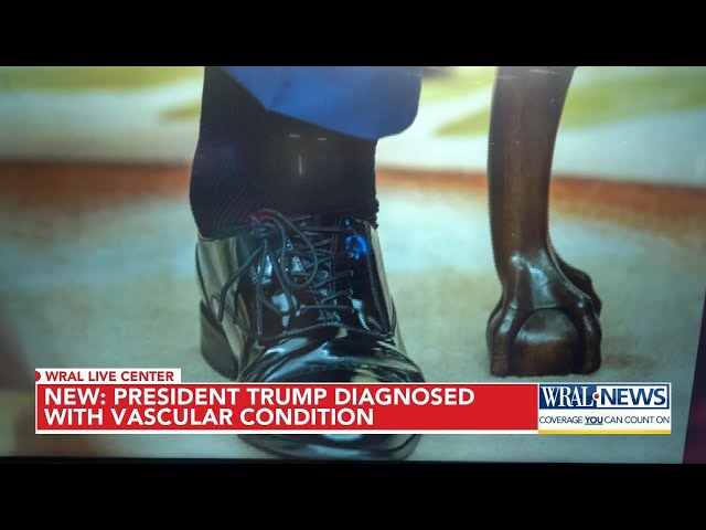 Trump diagnosed with chronic venous insufficiency following leg swelling