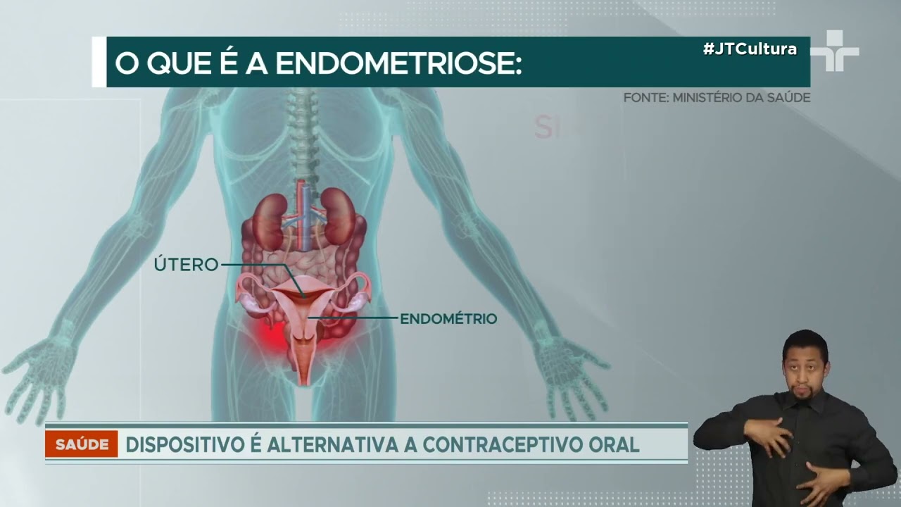 SUS deve oferecer DIU hormonal para tratamento da endometriose até o fim do ano