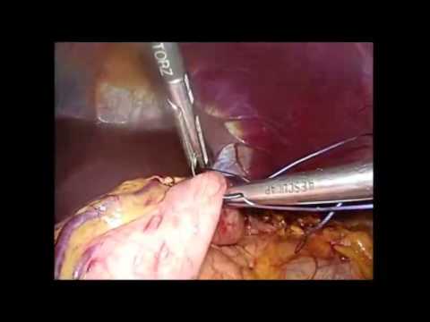 Medial Approach in Laparoscopic Distal Pancreatectomy for Preservtion of the Splenic Vessels 