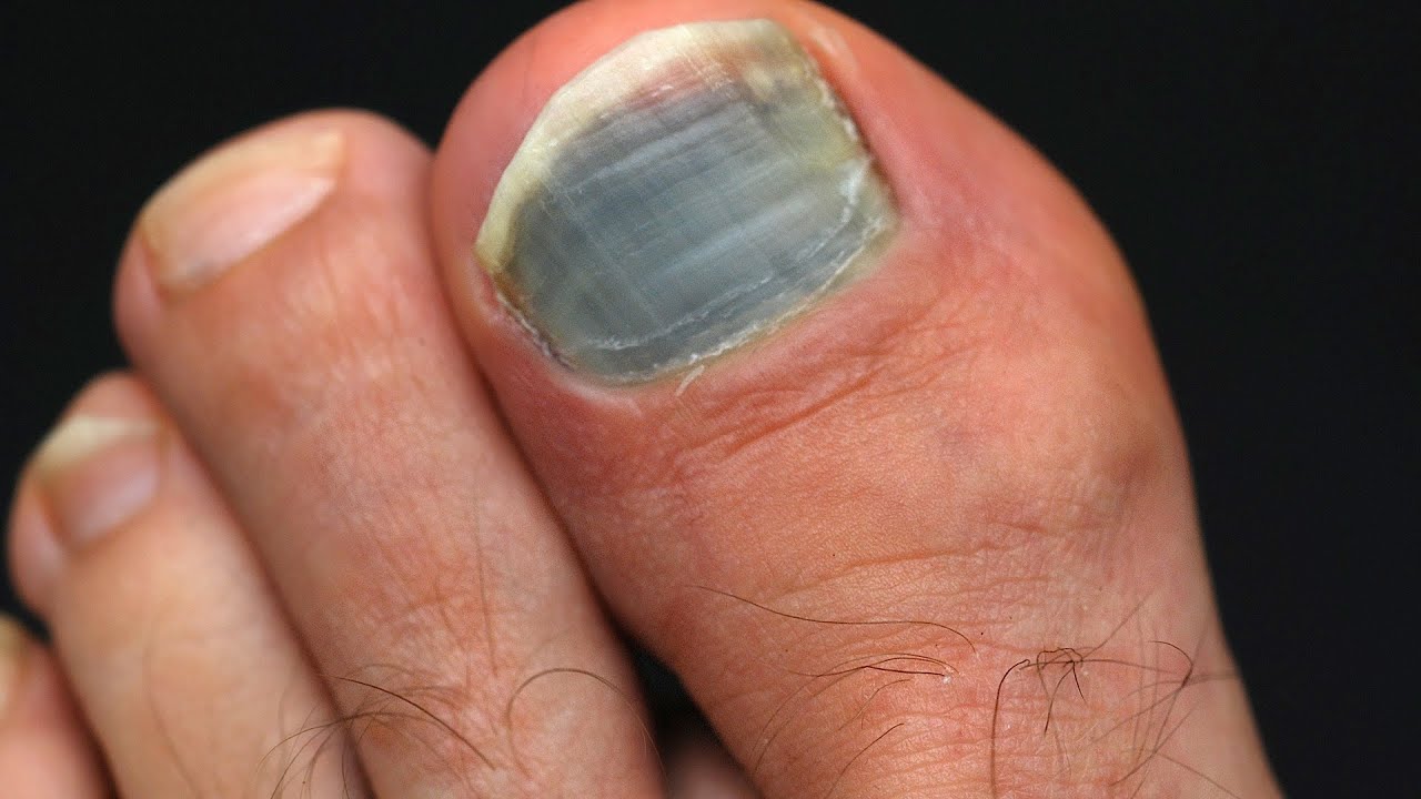 How To Prevent Treat Black Toenail Foot Care YouTube