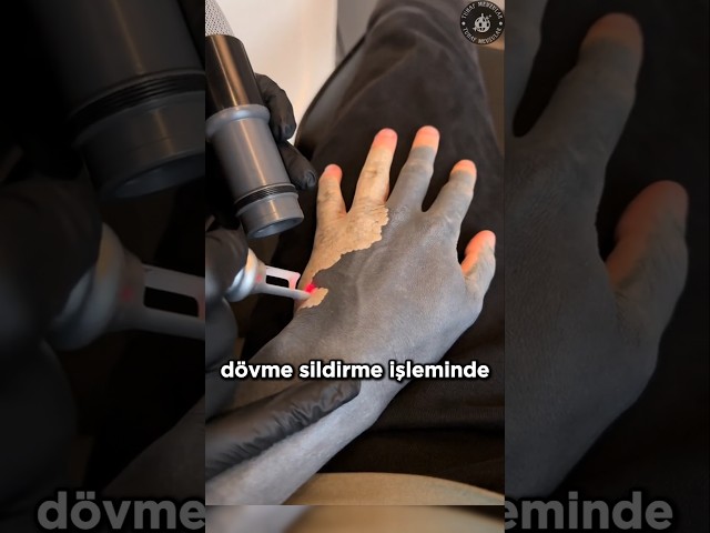 Silinen Dövmelerdeki Mürekkepler Nereye Gidiyor? ✒️ ✍🏻 😲