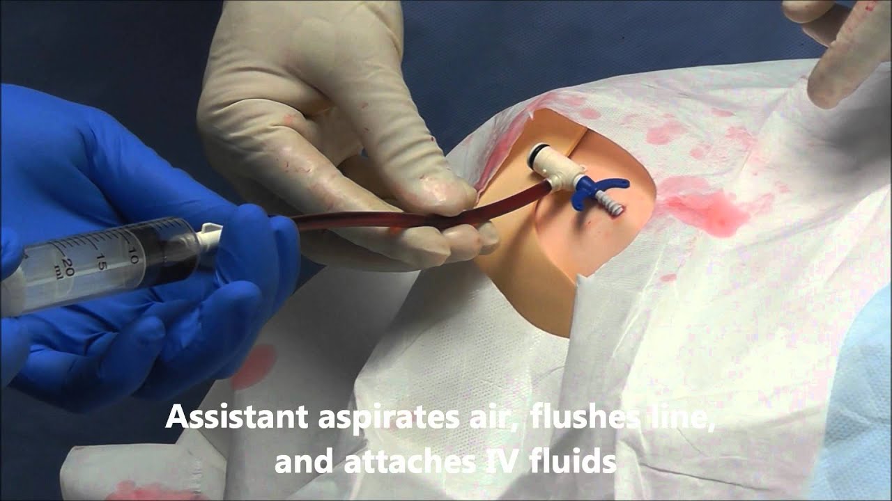 Pulmonary Artery Swan Ganz Catheter Insertion YouTube pulmonary-artery-swan-ganz-catheter-insertion-youtube