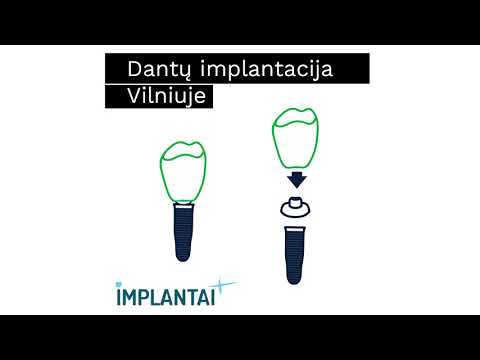 Implantaiplius - dantu implantai Vilniuje