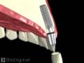 Implantul dentar, animatie 3D