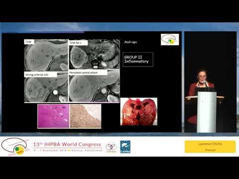 US13 Liver Cell Adenoma: Impact of the New Classification